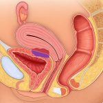 Symptoms and Causes of Endometriosis