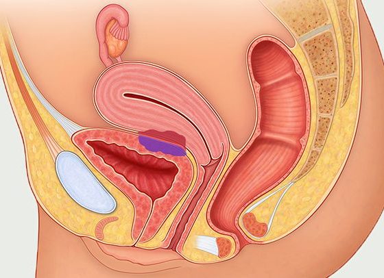 Symptoms and Causes of Endometriosis