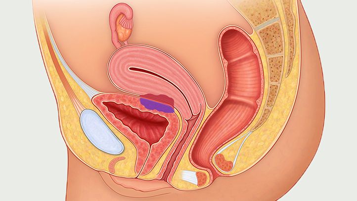 Symptoms and Causes of Endometriosis